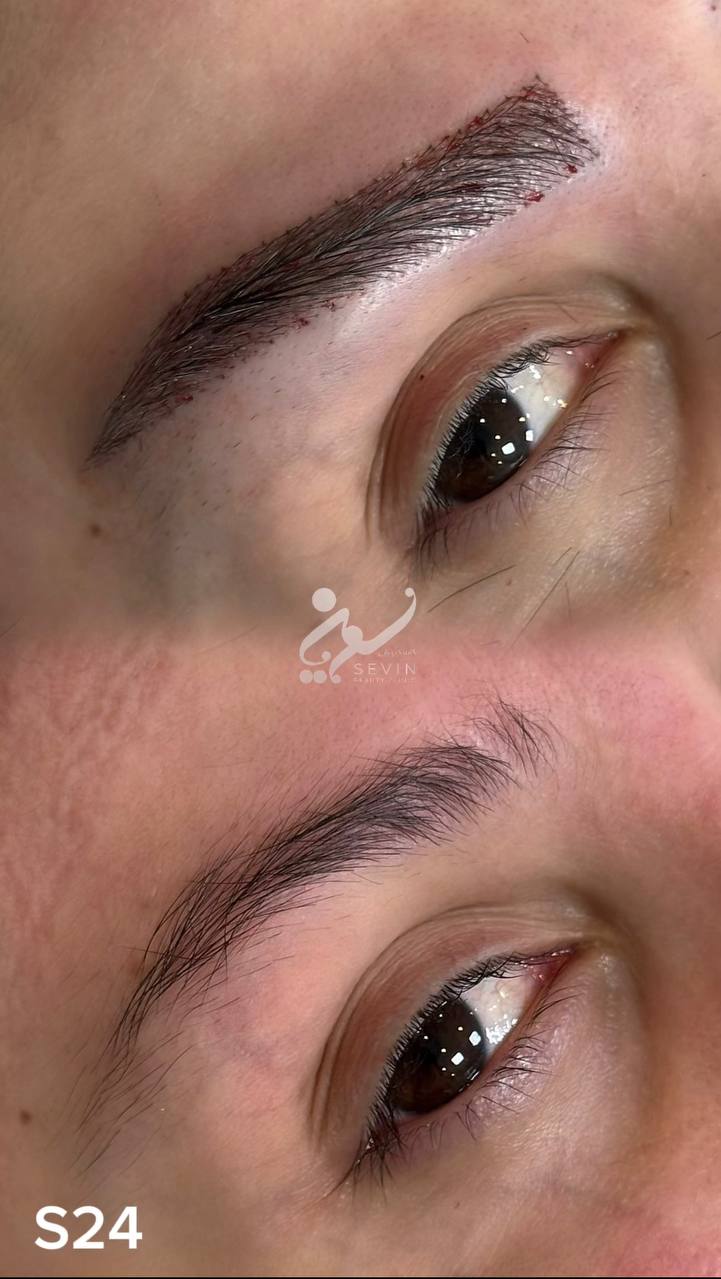 نمونه کاشت ابرو در کلینیک سوین